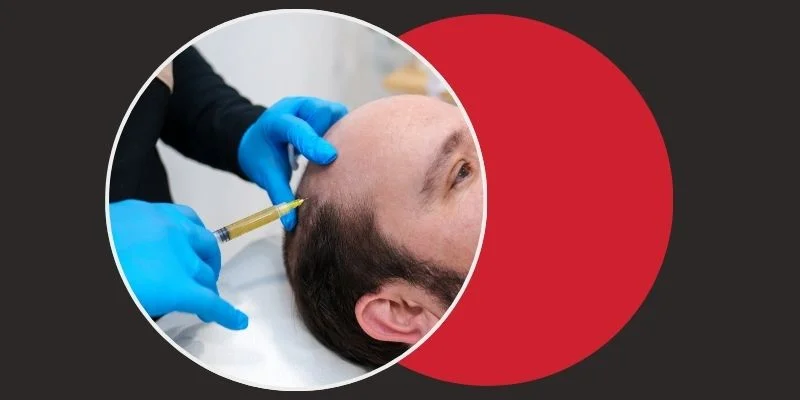 PRP Hair Treatment in Chennai