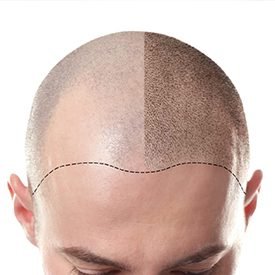 adgrohair-scalp-miro-pigmentation-2-275x275